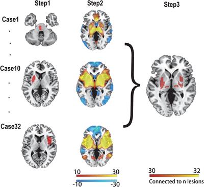 Lesions causing post-stroke spasticity localize to a common brain network